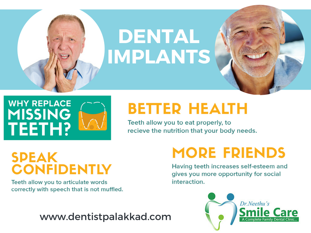 Dental Implants